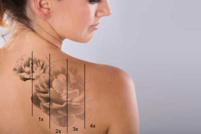 women showing stages of tattoo removal