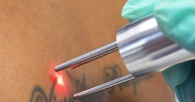 Reversing the Ink: How to Choose the Best Tattoo Removal Specialist image
